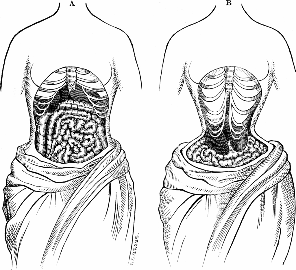 Deformación del cuerpo debido a la corsetería