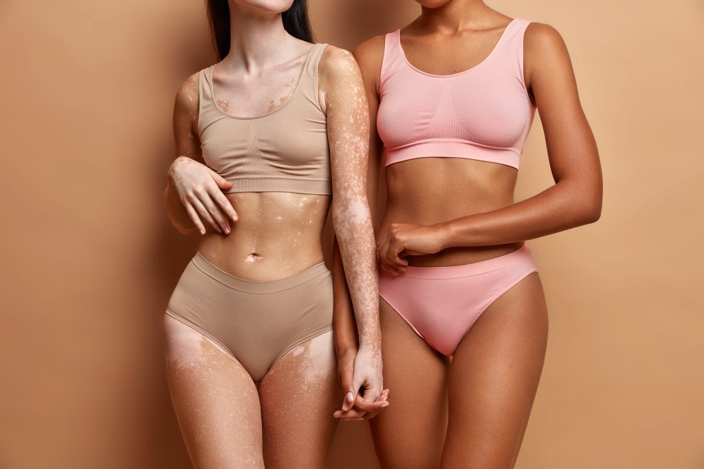 Duas mulheres de diferentes raças e condições de pele, vestidas com lingerie, posam contra um fundo bege.